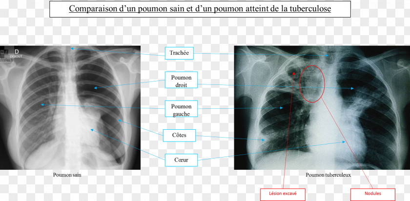 Fumer Tuberculosis Radiology Lung Medicine Infectious Disease PNG