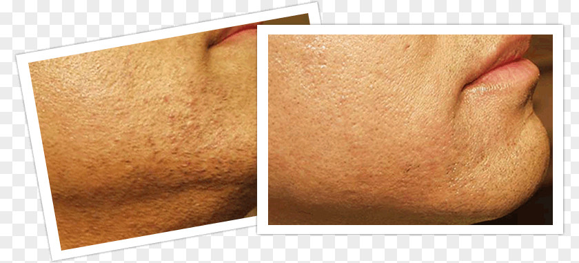 Laser Treatment Hair Removal Skin PNG