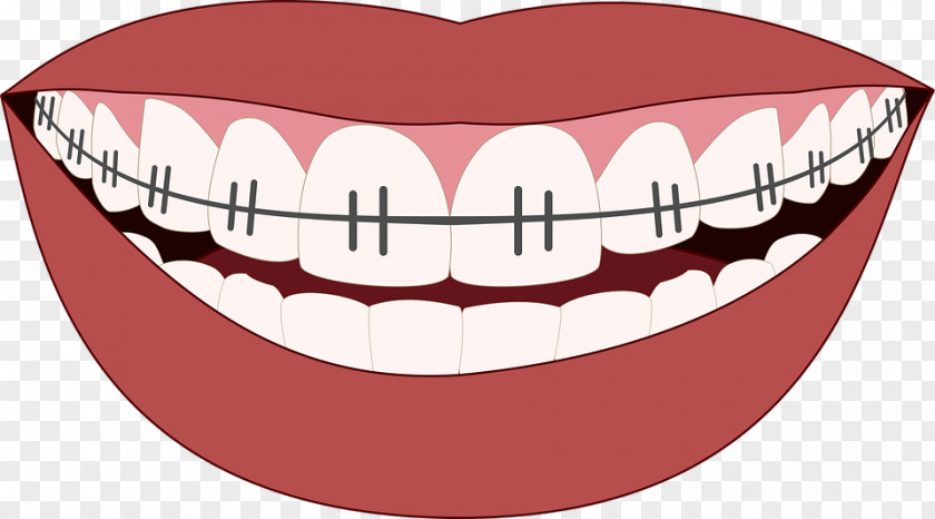 Orthodontist Cosmetic Dentistry Orthodontics Dental Implant PNG