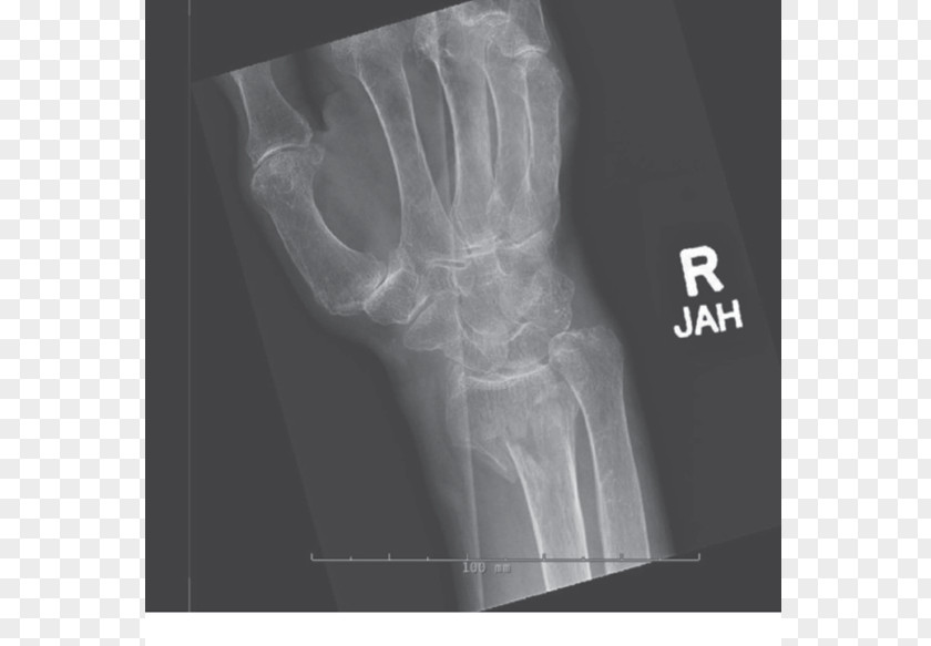 Arm X-ray Bone Fracture Distal Radius Shoulder PNG