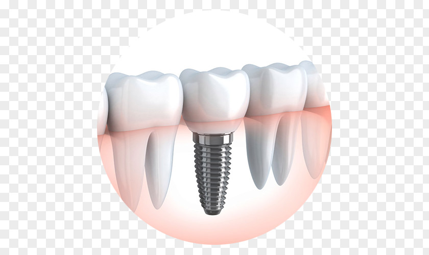 Sani Dental Group Implant Cosmetic Dentistry Surgery PNG