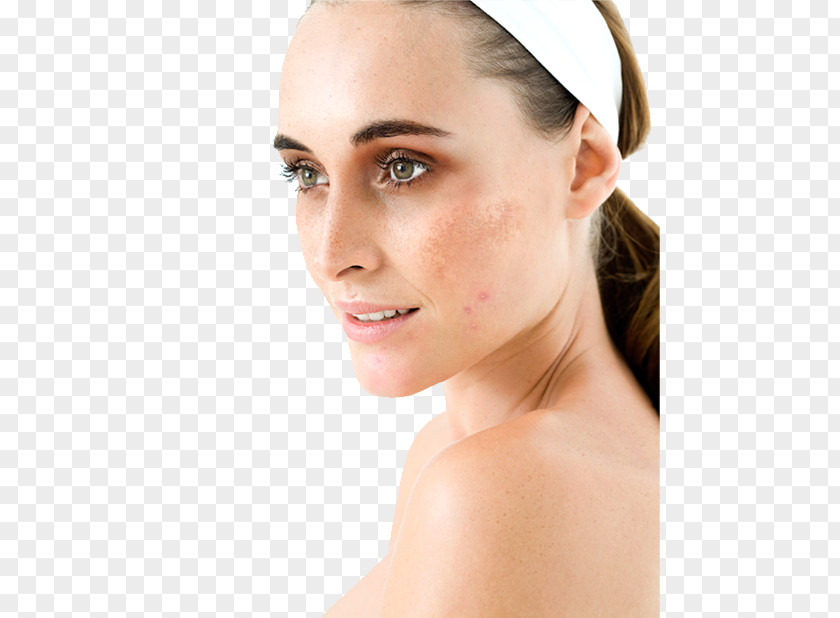 Face Hyperpigmentation Melasma Therapy Human Skin Color PNG
