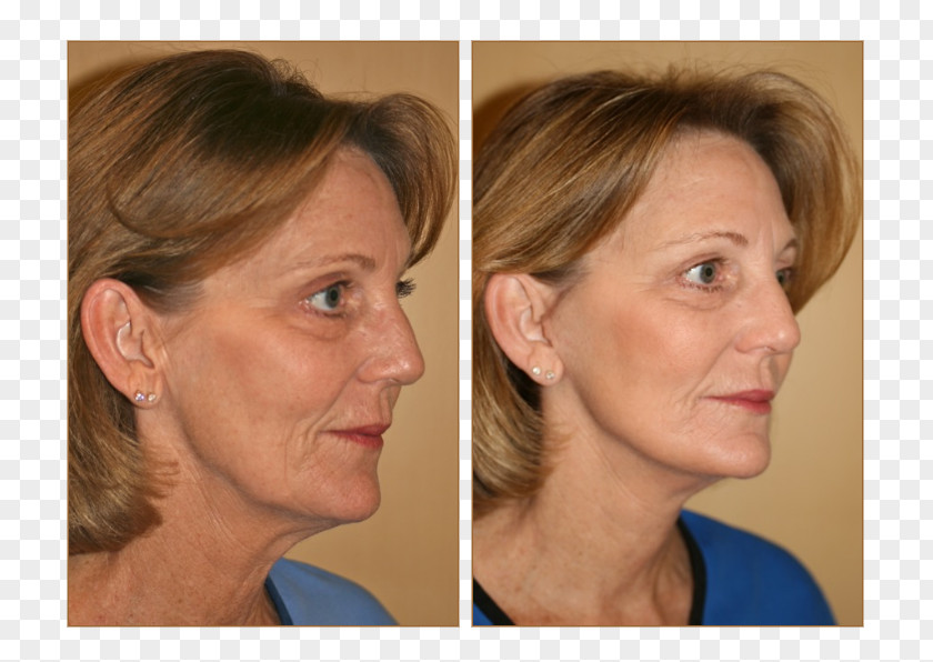 Face Cheek Rhytidectomy Lifestyle Lift Surgery PNG