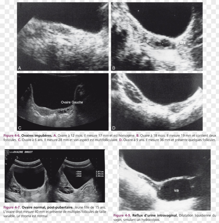 VAGIN Ovary Gynecologic Ultrasonography Ovarian Follicle Cyst PNG
