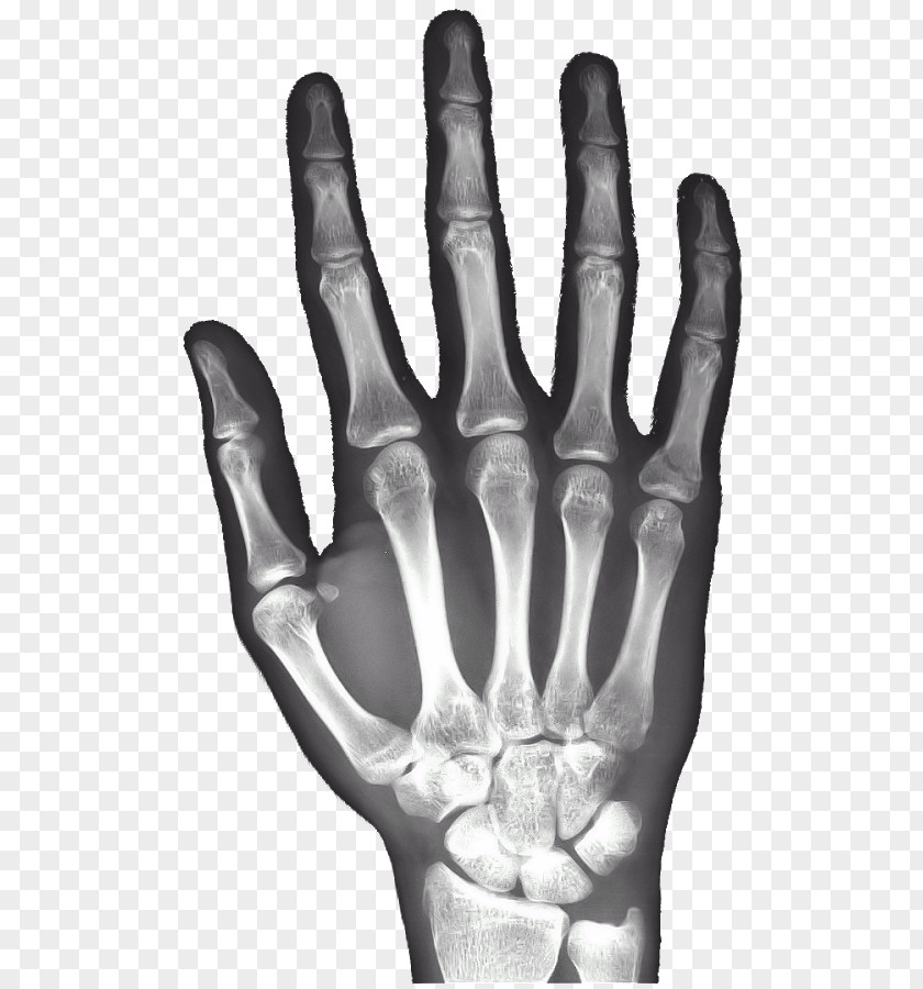 Rays X-ray Hand Carpal Bones Android PNG