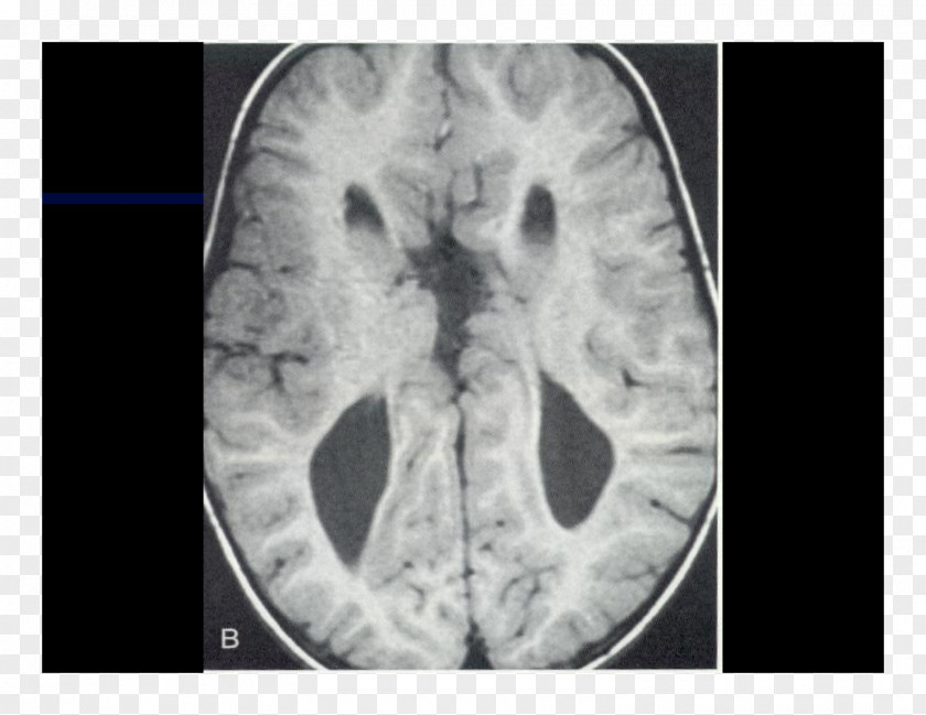Brain Computed Tomography Lääketieteellinen Röntgenkuvaus X-ray Radiography PNG