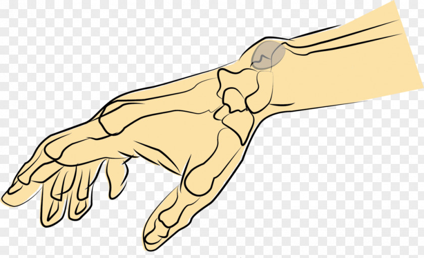 Hand Thumb Synovial Cyst Membrane PNG