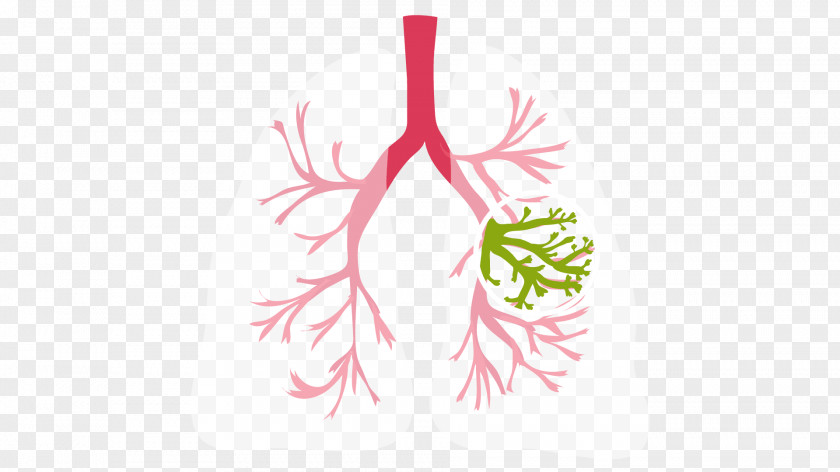 Lungs Cystic Fibrosis Lung Medical Diagnosis Symptom Solitary Pulmonary Nodule PNG