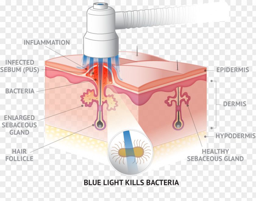 Pimples Propionibacterium Acnes Light Therapy Skin PNG