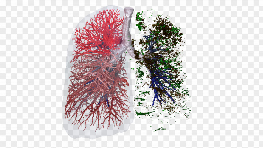 Respiratory Clinical Trial Lung System FLUIDDA Nv Information PNG