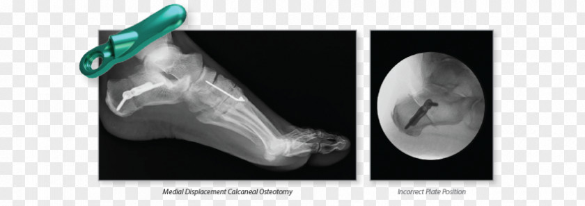 Foot Closeup Osteotomy Calcaneus Bone Joint Wright Medical Group PNG
