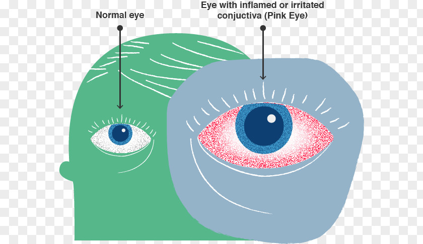 Centers For Disease Control And Prevention Eye Conjunctivitis Infection Health Medical Sign PNG