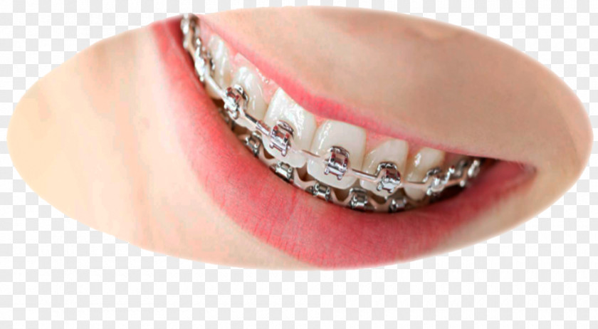 Sugar Skull Orthodontics Dental Braces Dentistry PNG