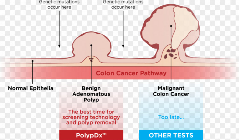 Colon Cancer Colorectal Polyp Adenoma Screening PNG