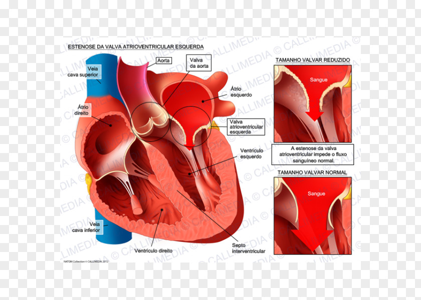 Heart Aortic Insufficiency Aorta Stenosis Ventricle Valve PNG