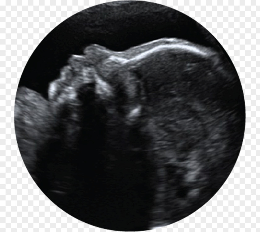 Babyultrasound 3D Ultrasound Ultrasonography Pregnancy Infant PNG