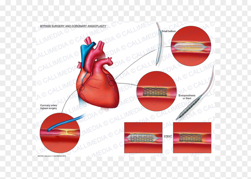 Heart Angioplasty Coronary Artery Bypass Surgery Stenting PNG