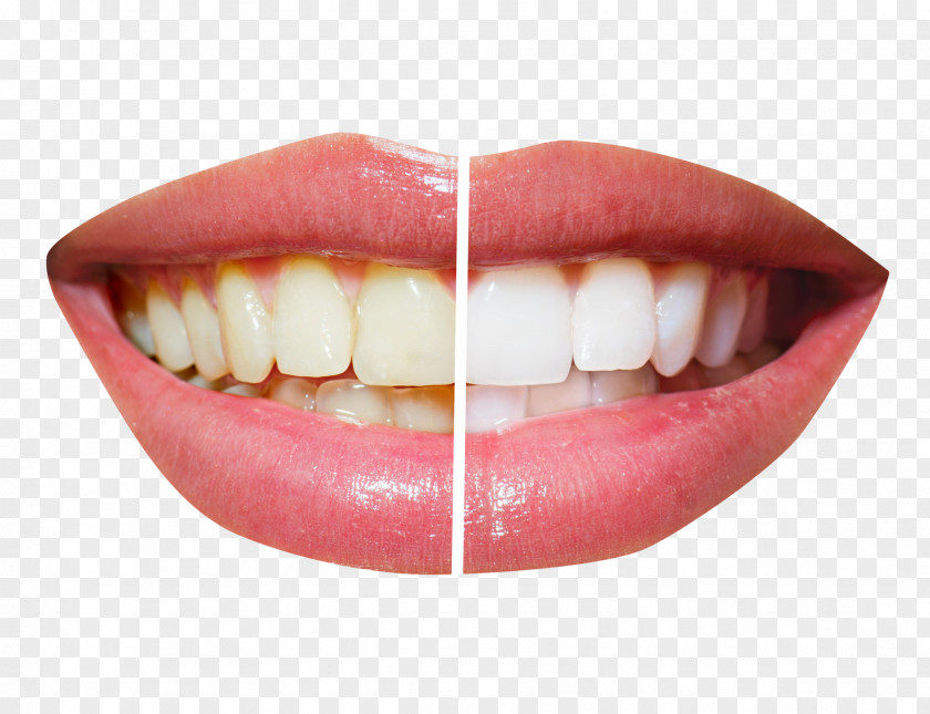 Teeth Whitening Cosmetic Dentistry Tooth PNG