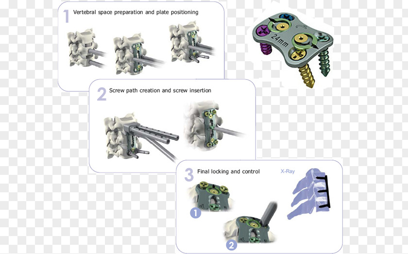 美术vi Arthrodesis Cervical Vertebrae Information Joint PNG