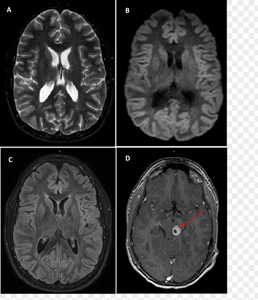 Gadoteric Acid Neurofibromatosis Type II Magnetic Resonance Imaging PNG