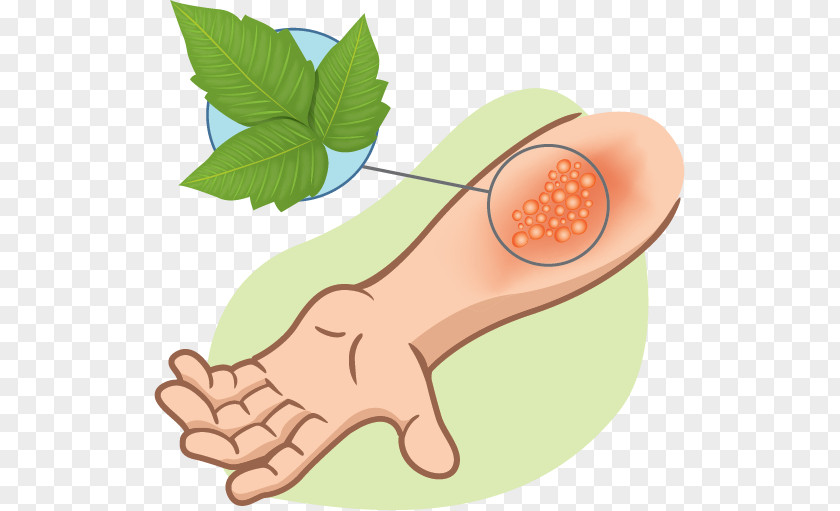 Scar Poison Ivy Western Oak Skin Rash Itch Tecnu PNG