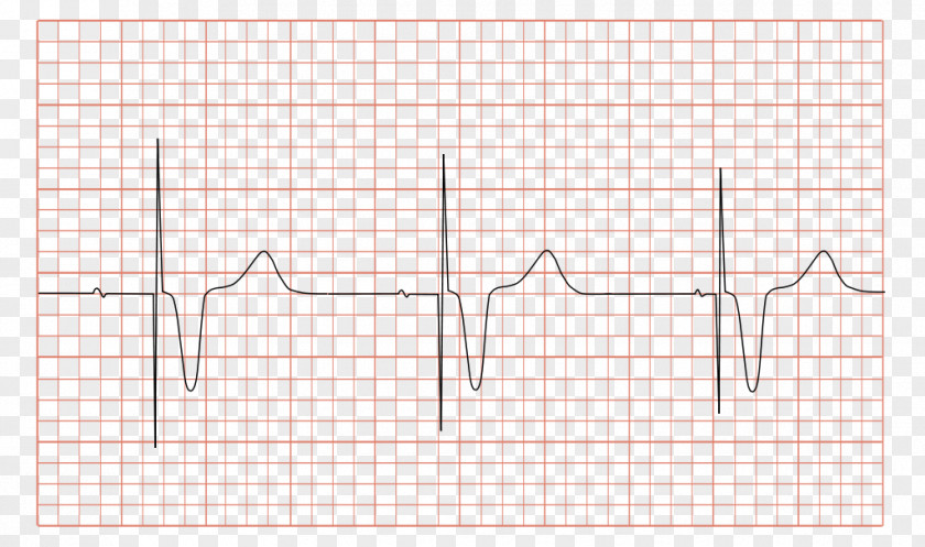 Ecg Artificial Cardiac Pacemaker Electrocardiography Syndrome Multifocal Atrial Tachycardia Medicine PNG