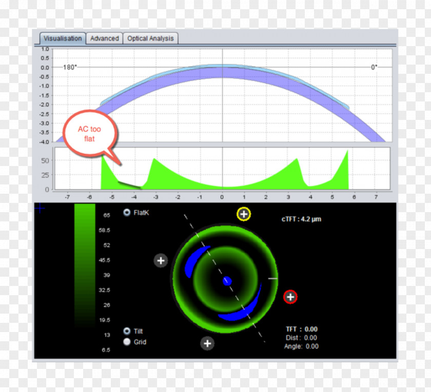 Orthokeratology Near-sightedness Cornea Optometry Astigmatism PNG