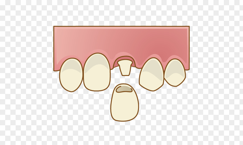 Sakayori Dental Clinic Dentistry 歯科 歯冠継続歯 PNG