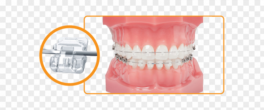 Damon Dental Braces System Orthodontics Dentistry PNG