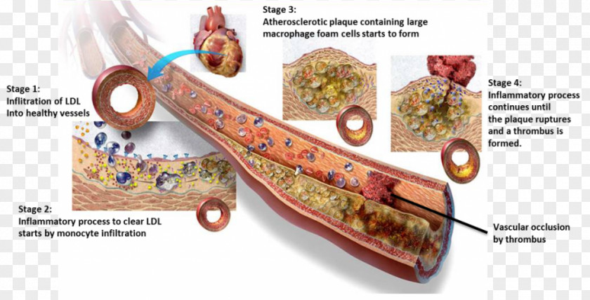 Arteriosclerosis Low-density Lipoprotein Foam Cell Atheroma Cardiovascular Disease PNG