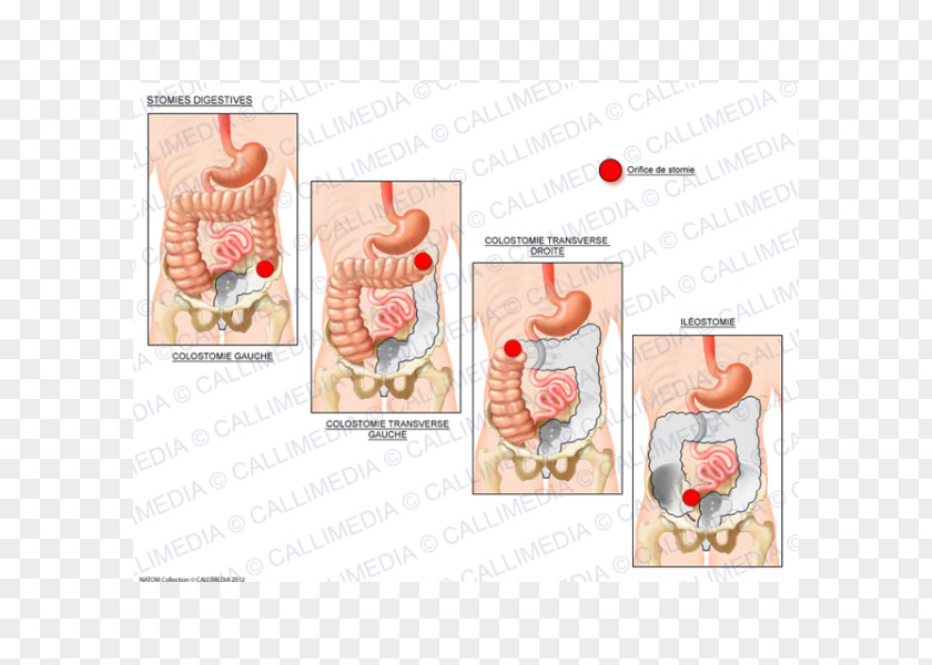 Endocrine System Stoma Ileostomy Ostomía Digestion Colostomy PNG