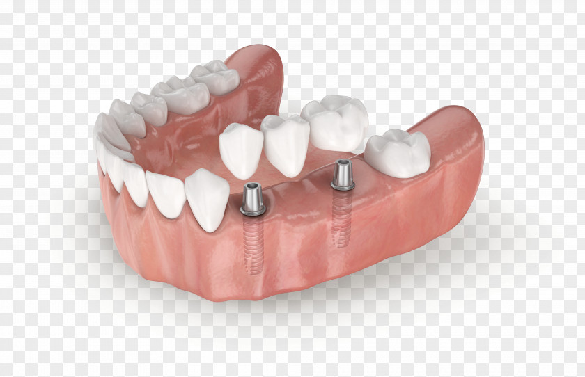 Tooth Jaw Dentures Dental Implant LASAK PNG