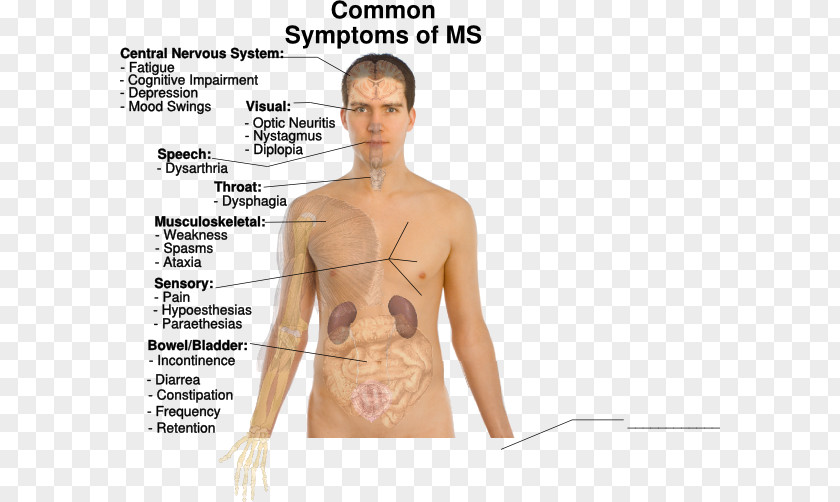 Multiple Sclerosis Symptom Clip Art PNG