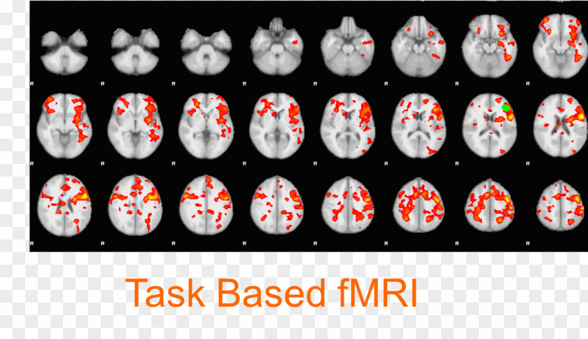 Brain Functional Magnetic Resonance Imaging Default Mode Network Neuroimaging PNG
