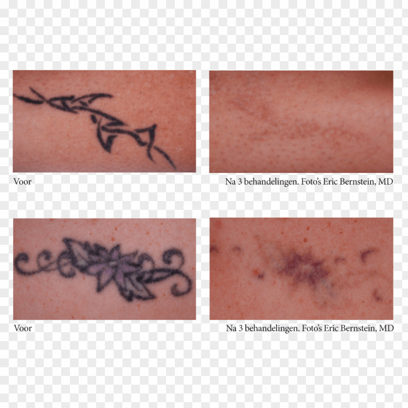 Dalton Laser Pico Tattoo Therapy Skin PNG