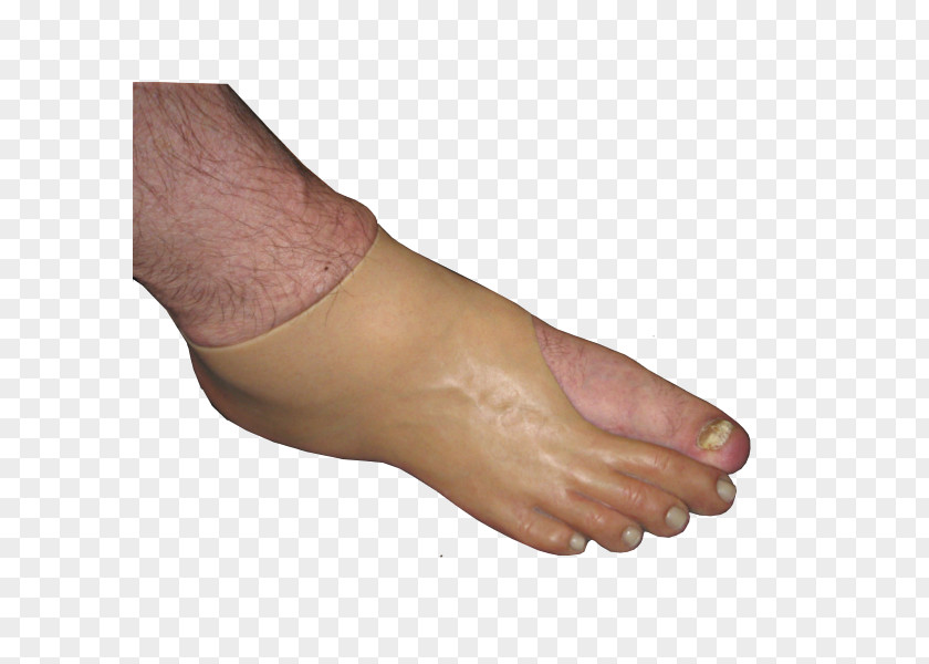 Hand Thumb Toe Foot Amputation Prosthesis PNG