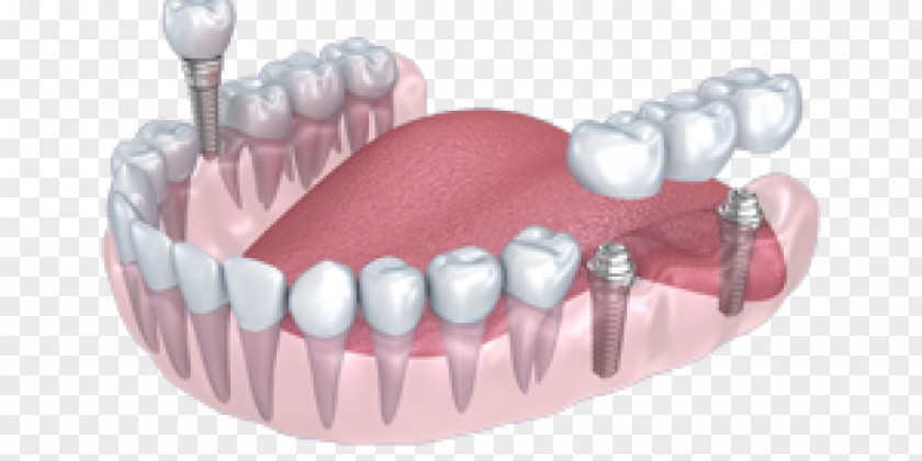 Crown Tooth Dental Implant Dentistry PNG