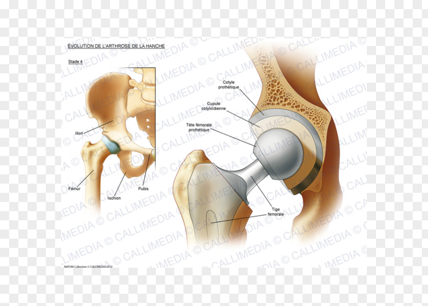 Ráº¯n 3d Hip Osteoarthritis Prosthesis Rheumatoid Arthritis PNG