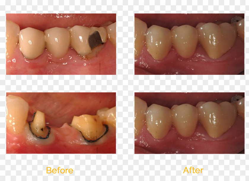 Bridge Tooth Molar Dentistry Dental Implant PNG