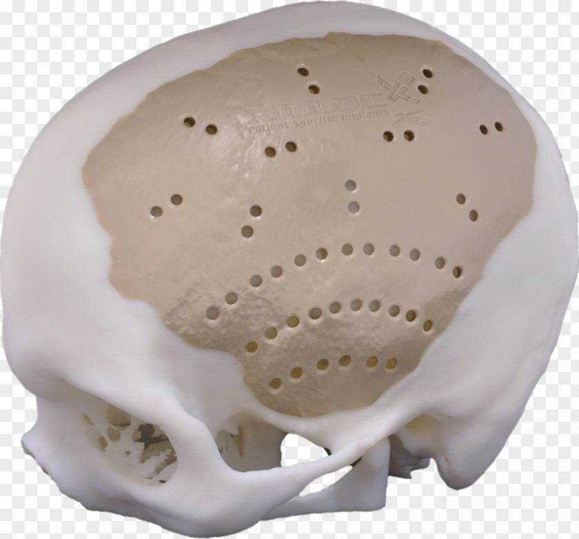 Towards The Left Implant Cranioplasty Polyether Ether Ketone Neurosurgery Craniotomy PNG