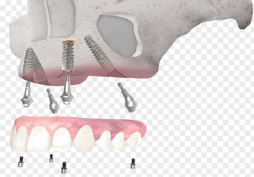 Osseointegration Tooth Dental Implant Dentistry All-on-4 PNG