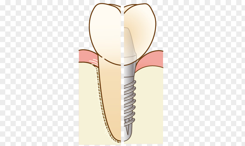 Bridge Dentist 歯科 Dental Implant Therapy Dentures PNG