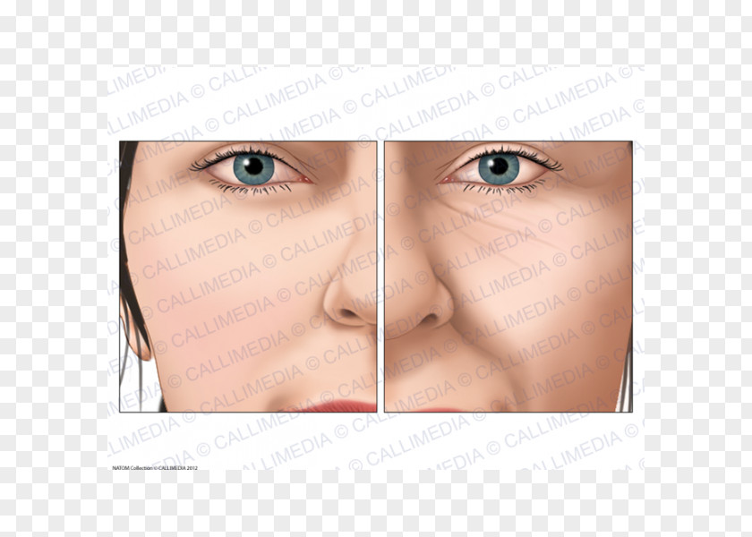 Nose Acromegaly Face Endocrinology Cheek PNG