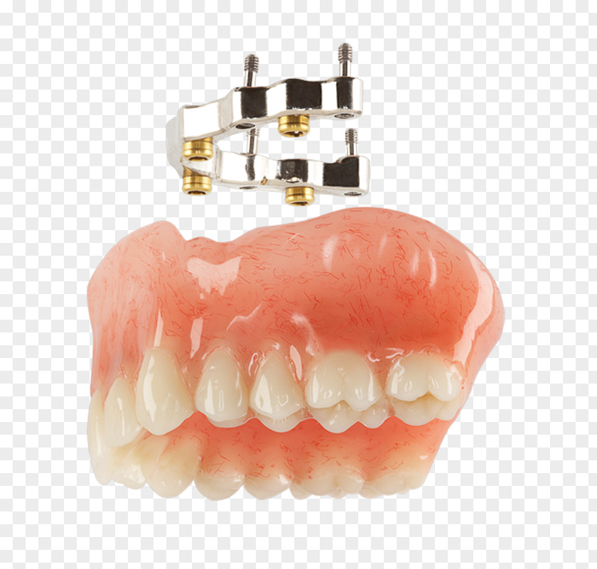 Overdenture Overdentures Tooth Dental Implant Bars PNG