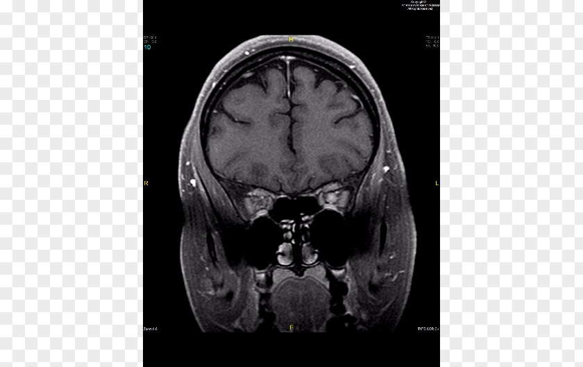 Skull Medical Radiography Computed Tomography Medicine Brain PNG