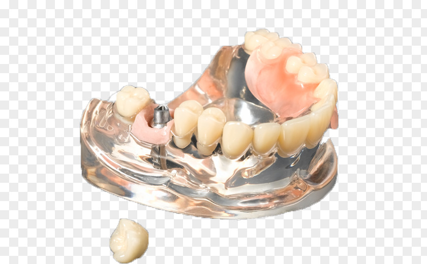 Crown Medic Company Limited Business Tooth Dental Implant PNG