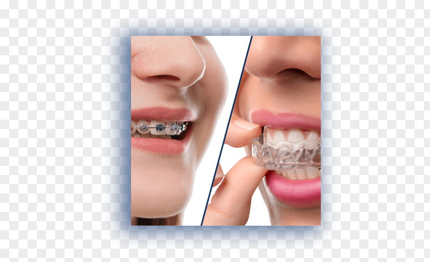 Orthodontist Clear Aligners Orthodontics Dental Braces Dentistry PNG