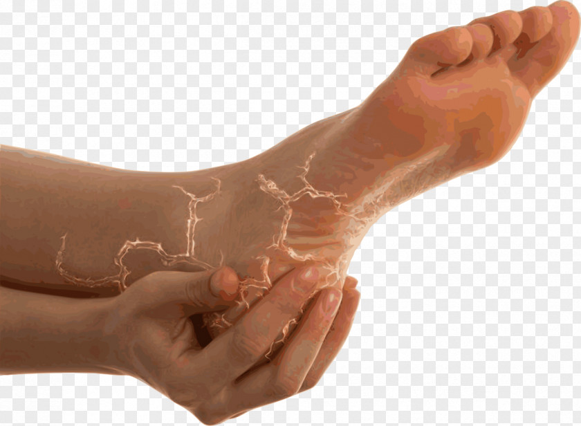 Heels Heel Pain Sole Foot Plantar Fasciitis PNG