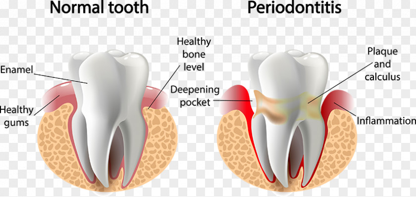 Health Periodontal Disease Gums Periodontology Dentistry PNG