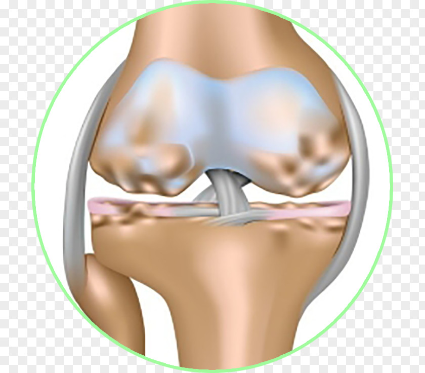 Khop Osteoarthritis Joint Effusion Knee PNG